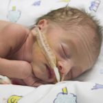 Premature baby
